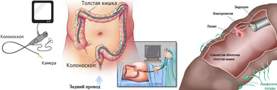 Колоноскопия (1).png Колоноскопия (1).png
